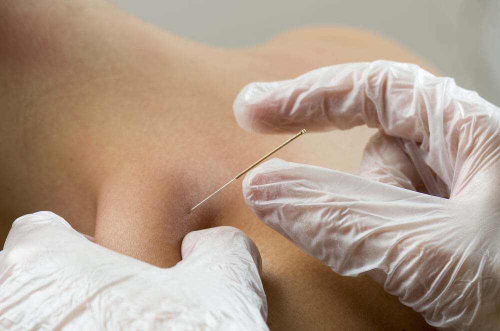 dry needling near you