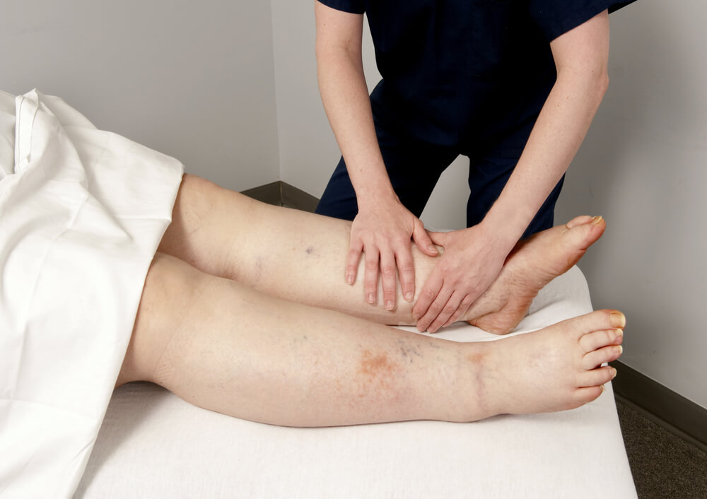 treatment for lymphedema