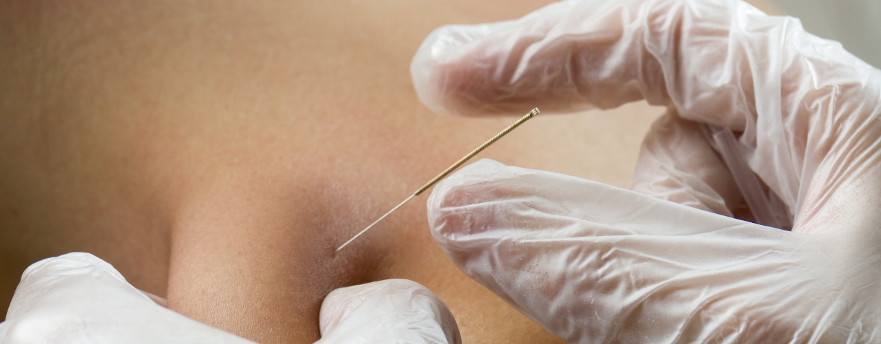 physical-therapy-clinic-dry-needling-riverbend-pt-river-ridge-metairie-la