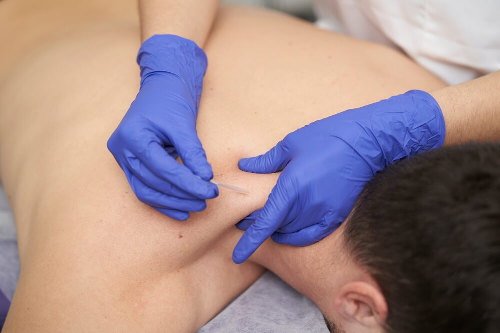 dry needling near me